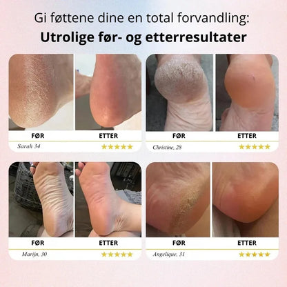 INOVAREC™ Elektrisk Fotfil – Glatt Hud På Sekunder